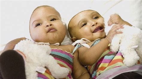 Conjoined Twins Successfully Separated Channel 4 News