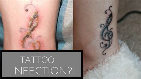 Tattoo Infection Youtube