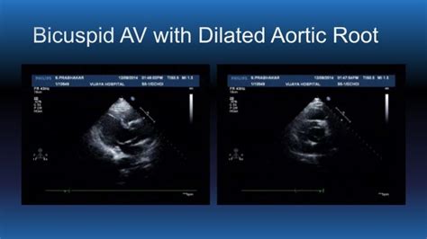 Echo Assessment Of Aortic Valve Disease