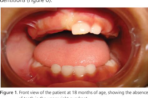 Regional Odontodysplasia Clinical ClÍnico Odontodisplasia Regional