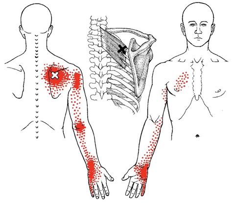 Dry Needling What It Is And How Does It Work