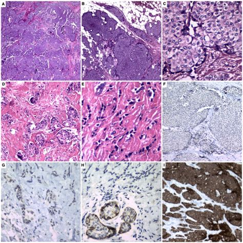 Invasive Solid Papillary Carcinoma With Invasive Lobular And Invasive