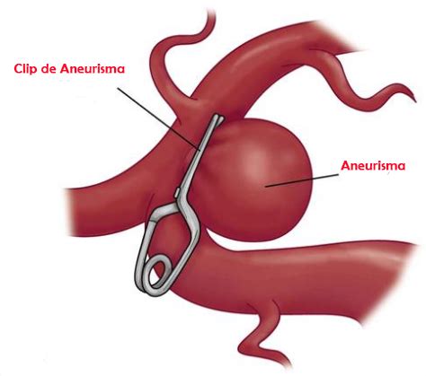 Kondisi ini sering kali tidak menimbulkan tanda dan gejala. Aneurisma Cerebral e os cuidados de Enfermagem - Enfermagem