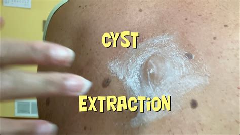 Pimple Popping A Cyst Youtube