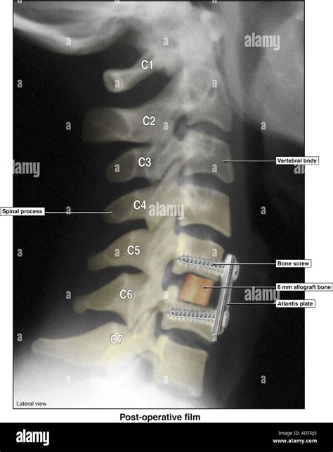 Anterior Cervical Discectomy And Fusion With Application Of Atlantis