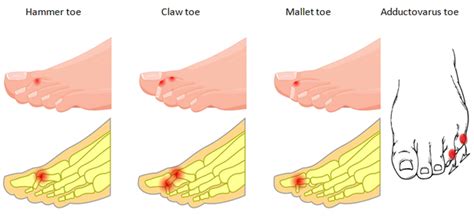 Management Of Toe Deformities — Chelsea And Westminster Hospital Nhs