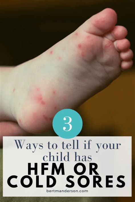 Hand Foot Mouth Disease Or Cold Sores Whats The Difference