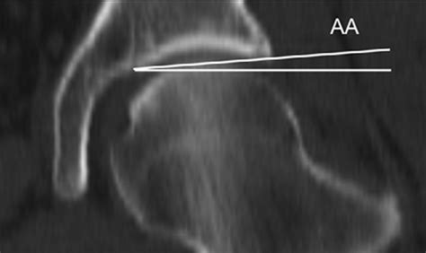 The Acetabular Index Angle Aa Angle Lateral Tilt Of The Acetabulum Download Scientific