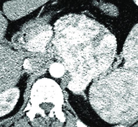 Abdominal Computed Tomography With Contrast Revealed A Circumscribed