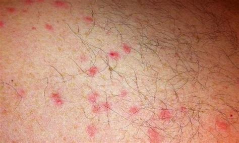 Scabies Pictures Rash Resource Scabies Rashes Scabies