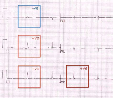 Now you can calculate the qrs axis as described in the classic formula, with leads i and iii (until now we used avf). Image result for right axis deviation ecg | Medical ...