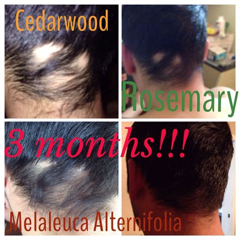 When it comes to its use, it has a widespread application in the cosmetic world, especially when it comes to hair treatment. These are the results of my boyfriend'a hair growth from a ...