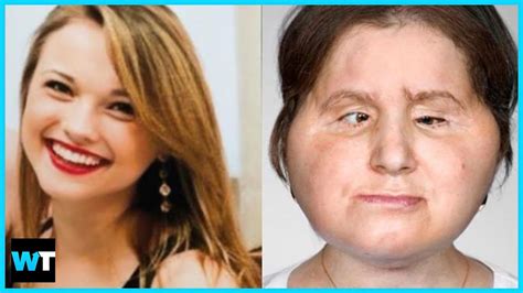 You Won’t Believe Katie Stubblefield’s Historic Face Transplant