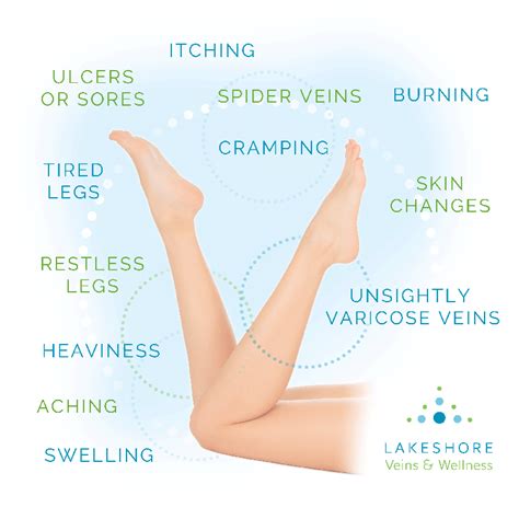 Preparing For A Varicose Vein Evaluation Appointment