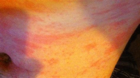 Hives Causes Risks Prevention And Pictures