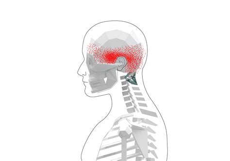 Suboccipitals Trigger Points Overview And Tips For Self Treatment