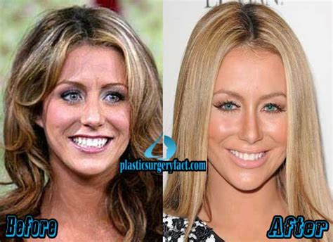 Aubrey Oday Plastic Surgery Before And After Photos