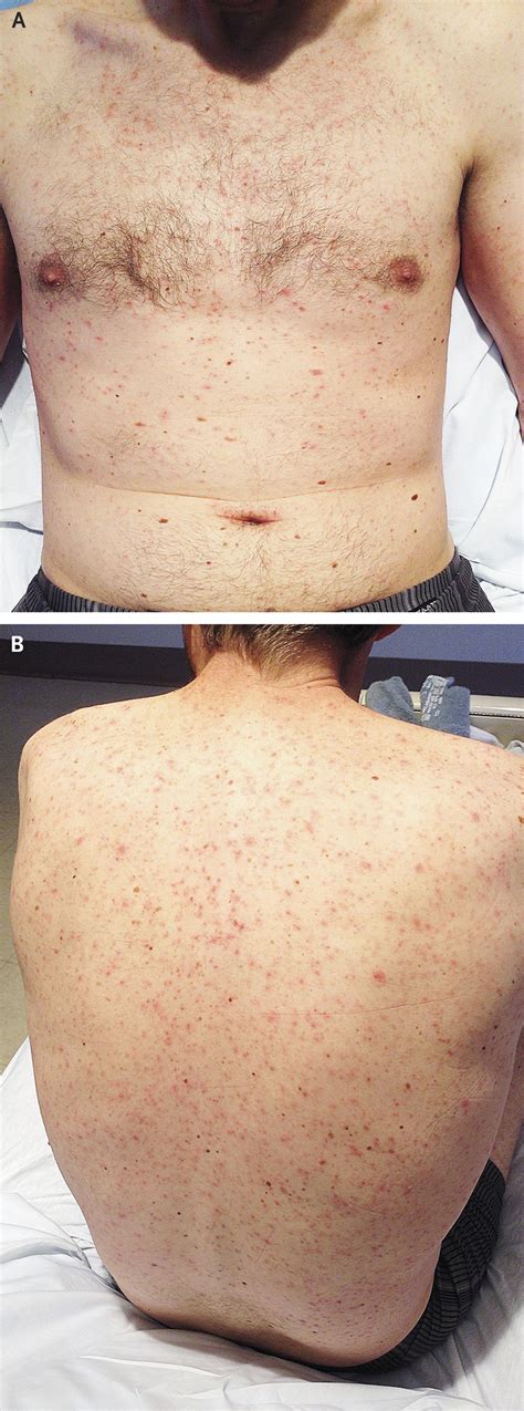 Case 23 2014 — A 41 Year Old Man With Fevers Rash Pancytopenia And