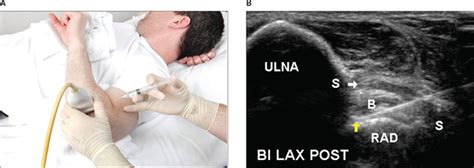 Sonographically Guided Distal Biceps Tendon Injections Sellon 2014