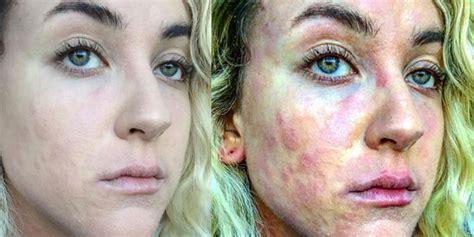 These Before-and-After Photos Show What It's Like to Live With Psoriasis | SELF