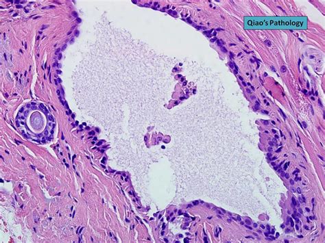 Qiaos Pathology Apocrine Hidrocystoma Molls Gland Cyst Of The