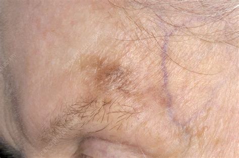 Precancerous Skin Lesion On Temple Stock Image M2100440 Science