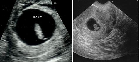 7th Week Of Pregnancy Ultrasound Pictures Pregnancywalls