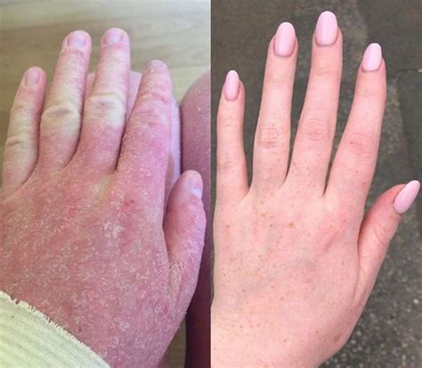 Eczema Sufferers Hell As Addiction To Prescribed Steroid Cream