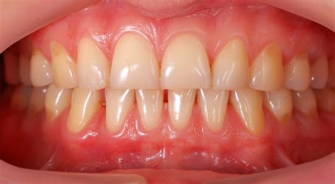 Saliva has minerals which harden over a period of time forming tartar. Stop Receding Gums - How can I stop my gums receding?