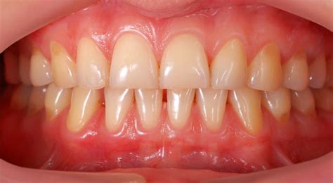 Green dental & orthodontics fights unhealthy teeth and gums with proactive education. Stop Receding Gums - How can I stop my gums receding?