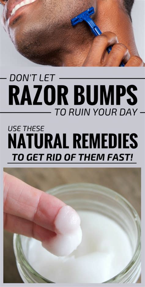 Pin By Beth Villines On General Razor Bumps Natural Remedies Razor