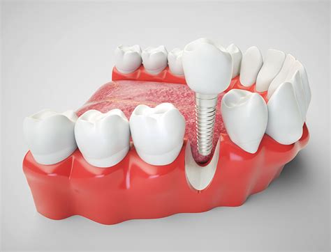 Dental Implants The Best Tooth Replacement Option Brampton Dentist
