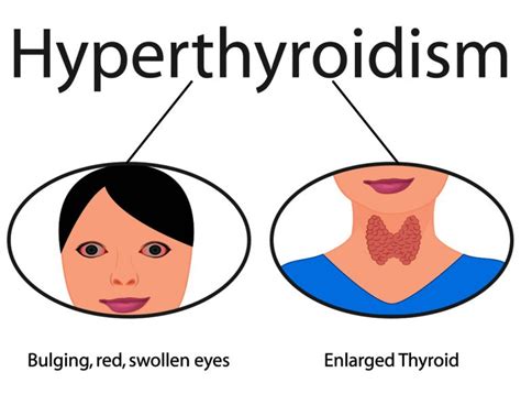Hyperthyroidism Edmonds Medical Clinic