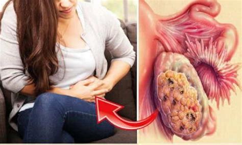 9 Early Warning Signs Of Ovarian Cancer Every Woman Must Know