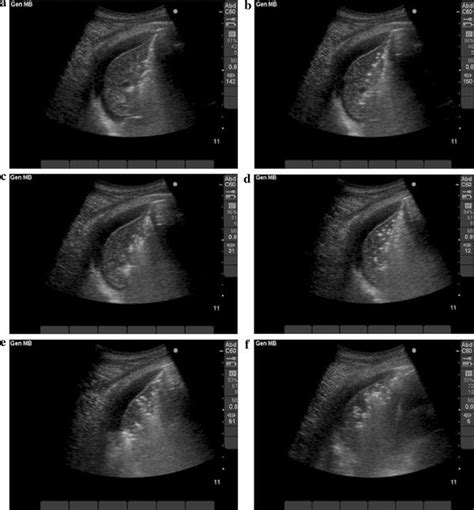 Detection Of Lung Atelectasisconsolidation By Ultrasound In Multiple