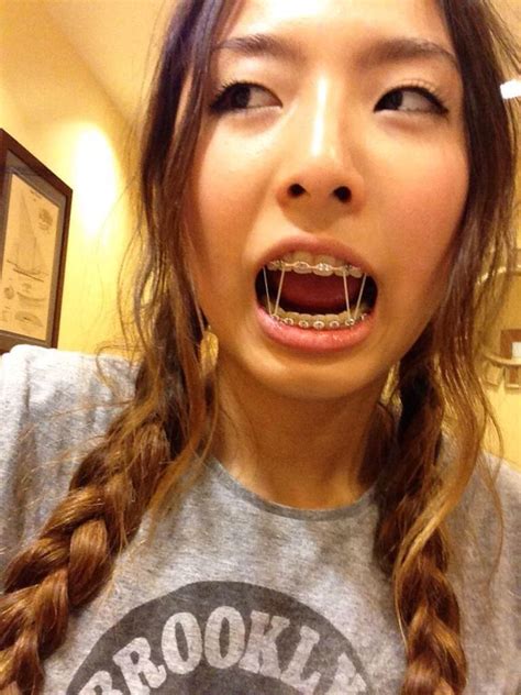 Asian Teen Girls With Braces Creatpic Store