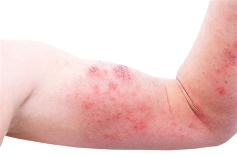 Atopic Dermatitis Ad Also Known As Atopic Eczema Is A Type Of Skin
