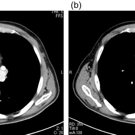 Contrast Enhanced Computed Tomography Ct Before A And After B