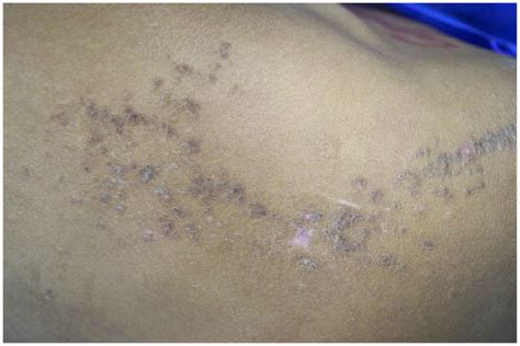 A Clinical Photograph Hyperpigmented Papules Coalescing Into Plaques
