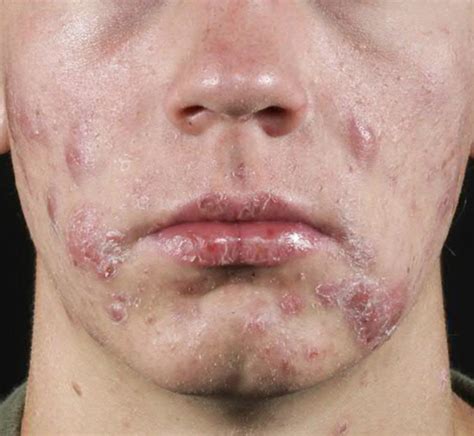 The Ultimate Solution To Cystic Acne Orlando Dermatology