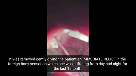 Immediate Relief After Huge Tonsil Stone Removal The Power Of Large
