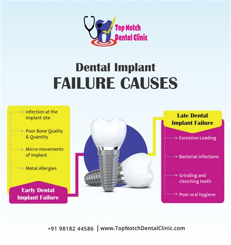 Dental Implant Complications And Failure Top Notch Dental