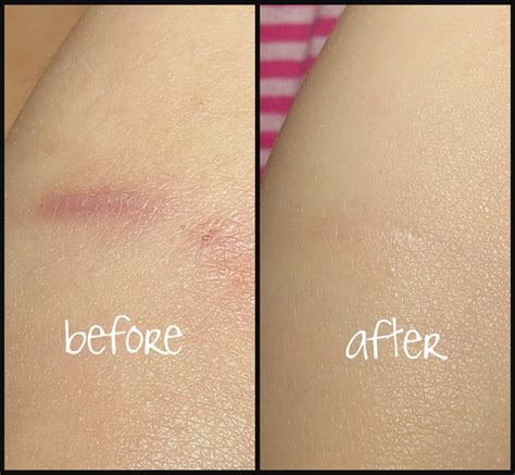 Invicible Scars Advanced Scar Treatment Photos And Review Blushing Noir