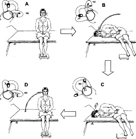 Table 1 From A Liberatory Maneuver For The Treatment Of Horizontal Canal Paroxysmal Positional