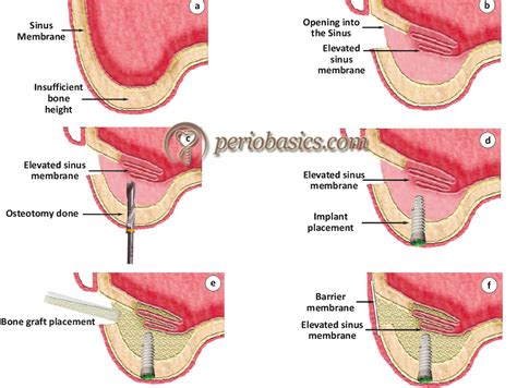 Clinical Procedure For Dental Implant Placement