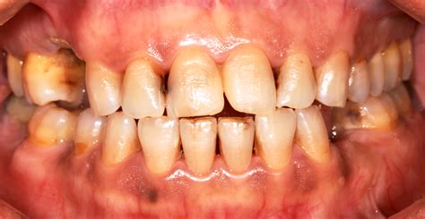 Types Of Gum Disease Orlando Periodontist