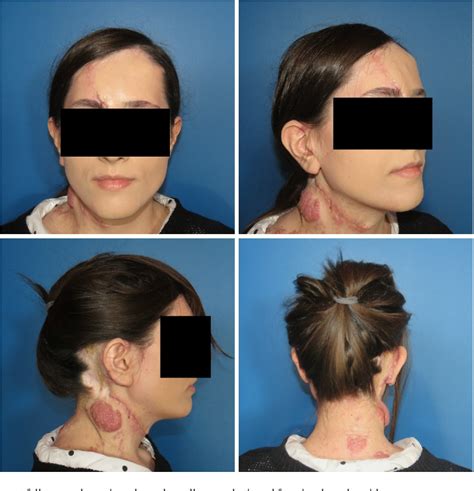 Figure 4 From A Rare Case Of Brooke Spiegler Syndrome Integrated
