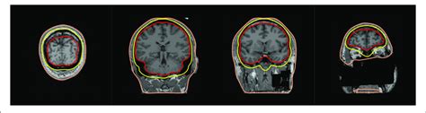 Bem Surfaces On Flash Mri Images The Inner Skull Outer Skull And