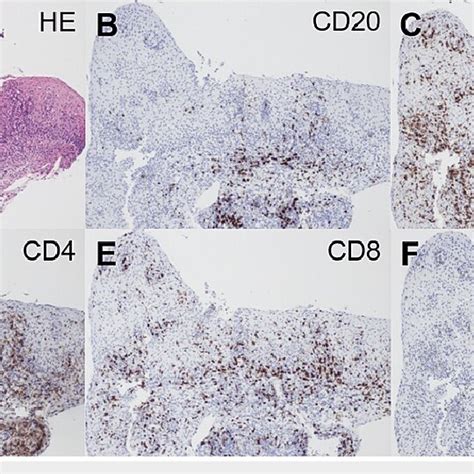 Histopathology Of The Esophagus In The Patient In Case 2 A Biopsy Of