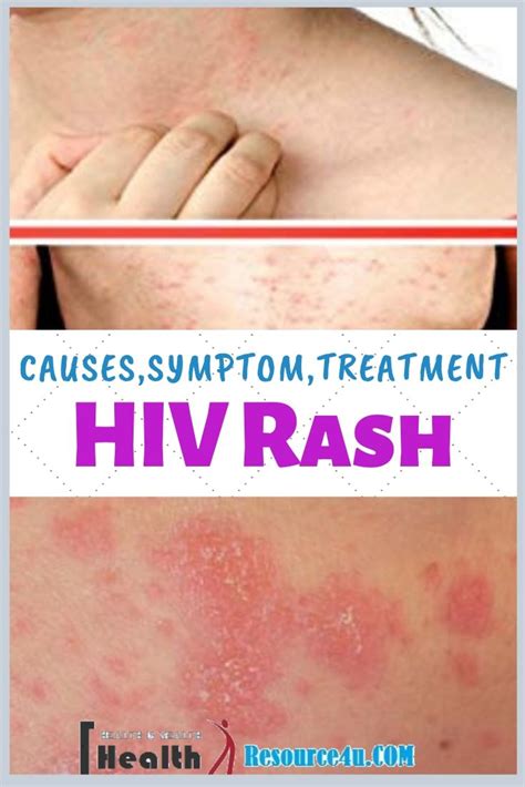 Hiv Rash Pictures Symptoms And Treatment Symptoms Causes Treatment Images And Photos Finder